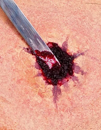 04500_00_prod_Wundenfuller_Anwendung.jpg Woundfiller