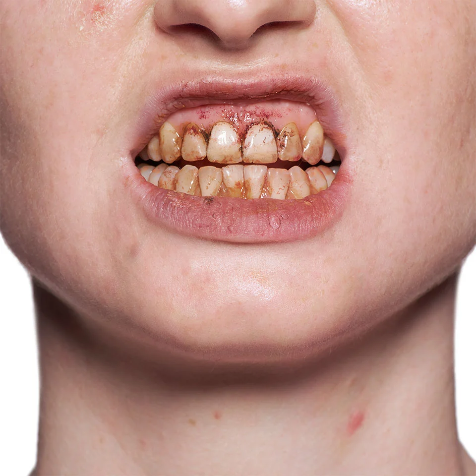 Tooth Enamel - Laca Dental