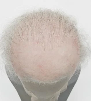 Silicone Bald Wig Natural Hair