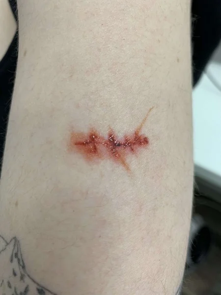 Scars and Sutures B