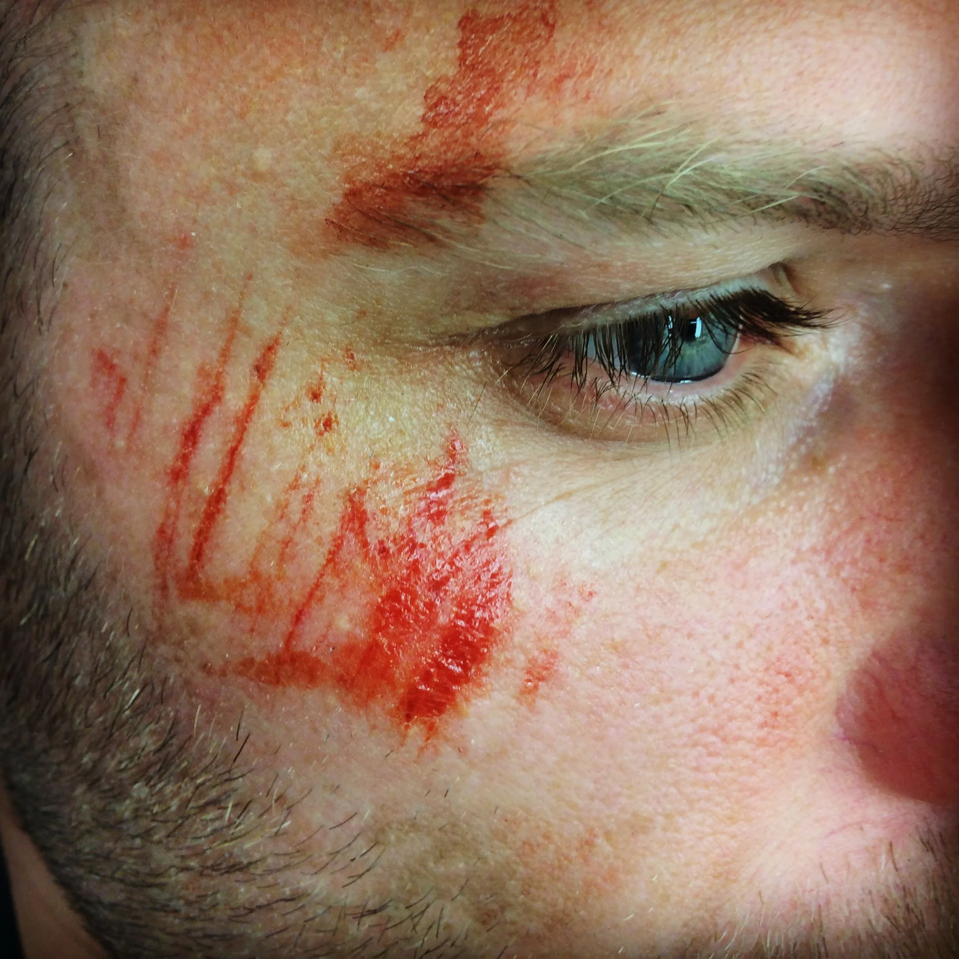 Skin Scrapes 1